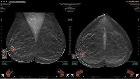 WorkstationOne for Breast Imaging