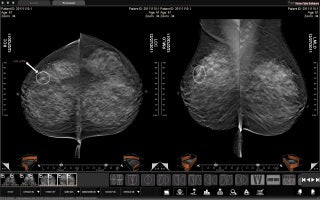 WorkstationOne for Breast Imaging